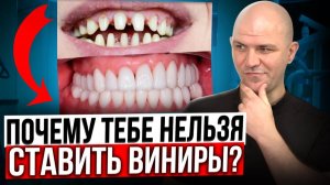 Вся правда про виниры! Кому стоит ставить? Сколько стоят виниры и сколько они прослужат?