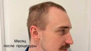 Как меняется прическа после пересадки волос в течение года.