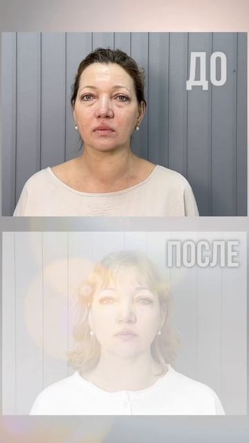 Результаты Микроигольчатого RF лифтинга в клиниках 