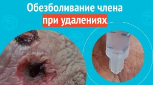 💉 Обезболивание члена при удалениях. Клинический случай №1633