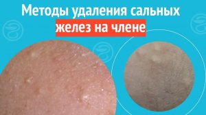 ✅ Методы удаления сальных желез на члене. Клинический случай №1642