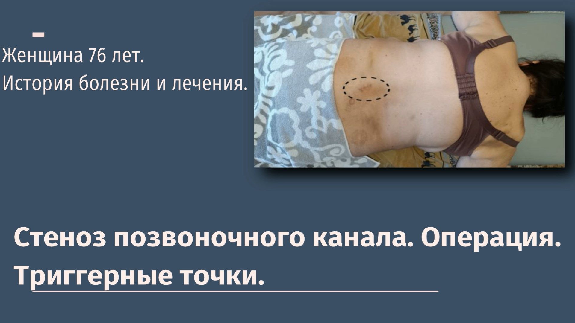 Стеноз позвоночного канала.