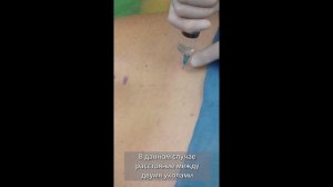 Методика ЛИТ коллагенами при НБНЧС