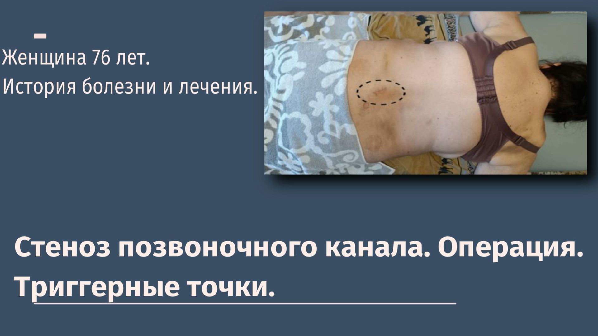 Стеноз позвоночного канала.