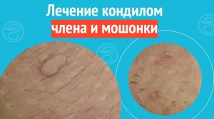 ✅ Лечение кондилом члена и мошонки. Клинический случай №1654