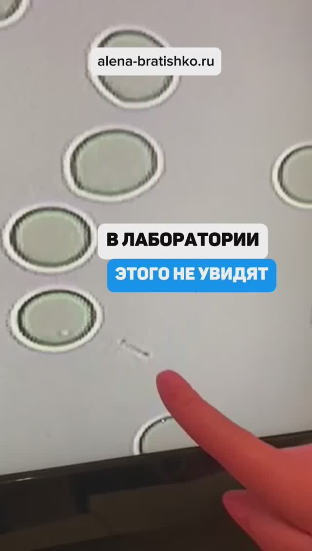 В лаборатории этого не увидят. Кандида в капле крови под микроскопом. Семейный доктор Алена Братишко смотреть онлайн