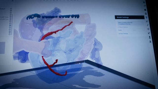3D-печать копии сердца подростка для планирования операции смотреть онлайн