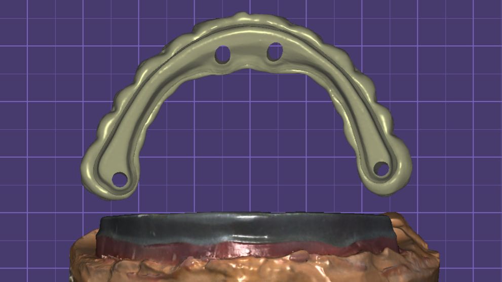 Как адаптировать моделировку к балочной конструкции в Exocad. смотреть онлайн