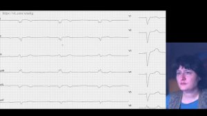 АВ-блокады: разбор интересных ЭКГ
