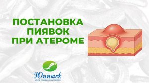 Постановка пиявок при атероме