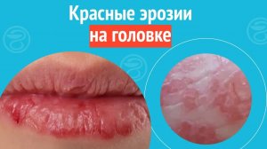😦 Красные эрозии на головке. Клинический случай №1653