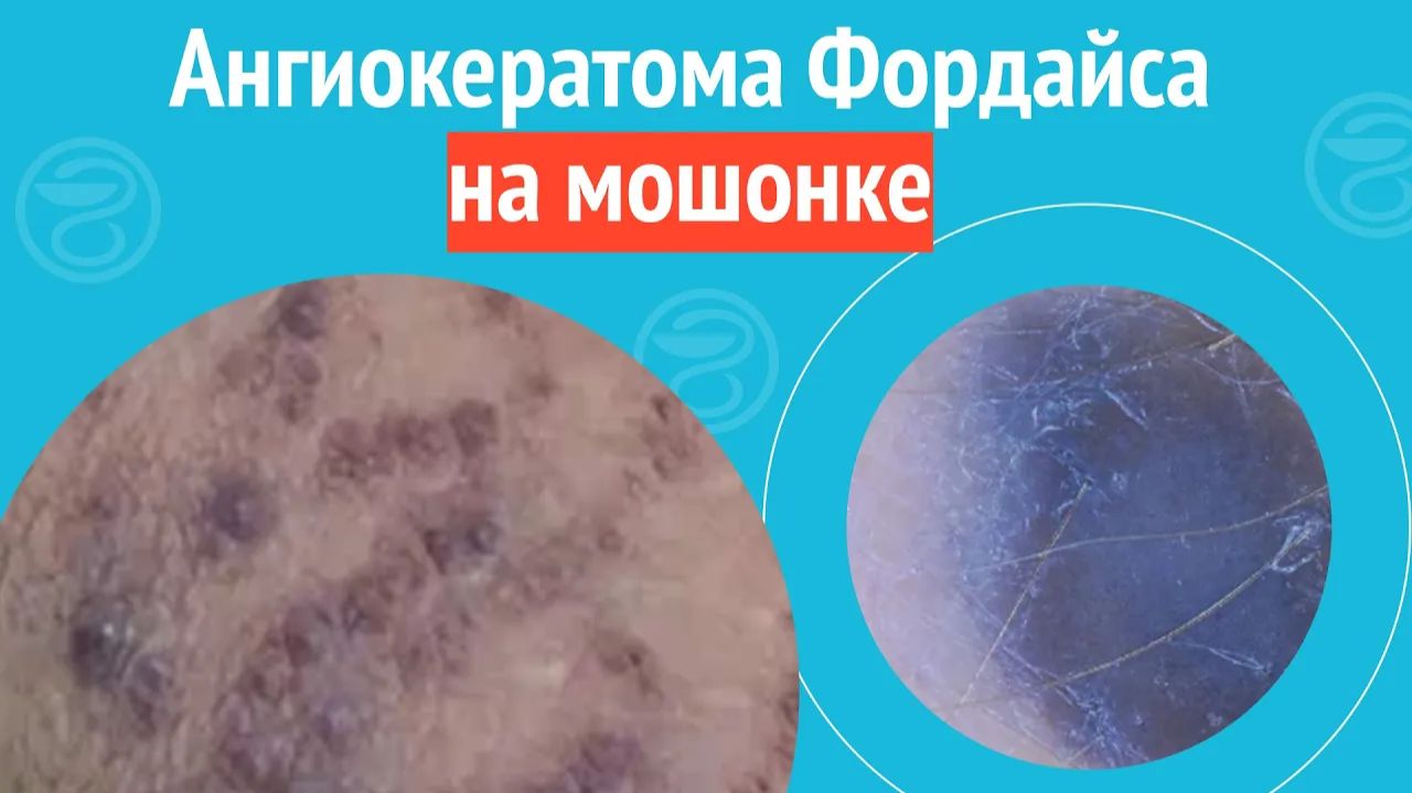 🙁 Ангиокератома Фордайса на мошонке. Клинический случай №1656 смотреть онлайн