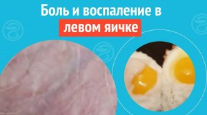😠 Боль и воспаление в левом яичке. Клинический случай №1678