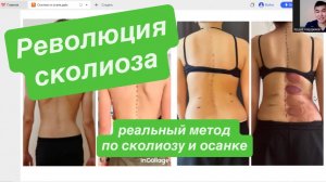 Сколиоз. Реальный работающий метод по исправлению сколиоза