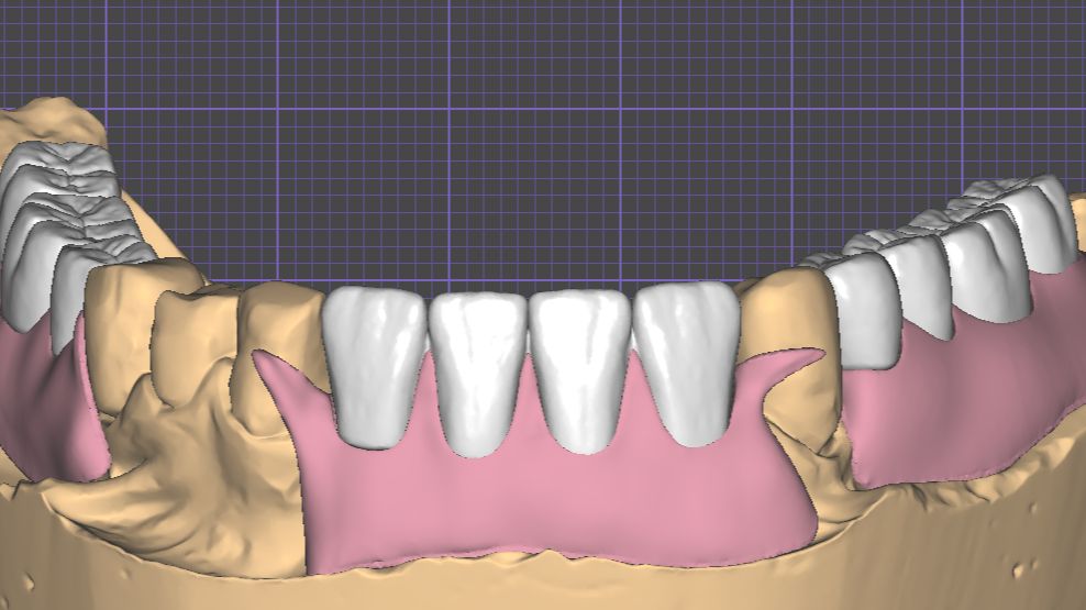Моделирование частично съемного протеза в ExoCad + совет по его печати смотреть онлайн