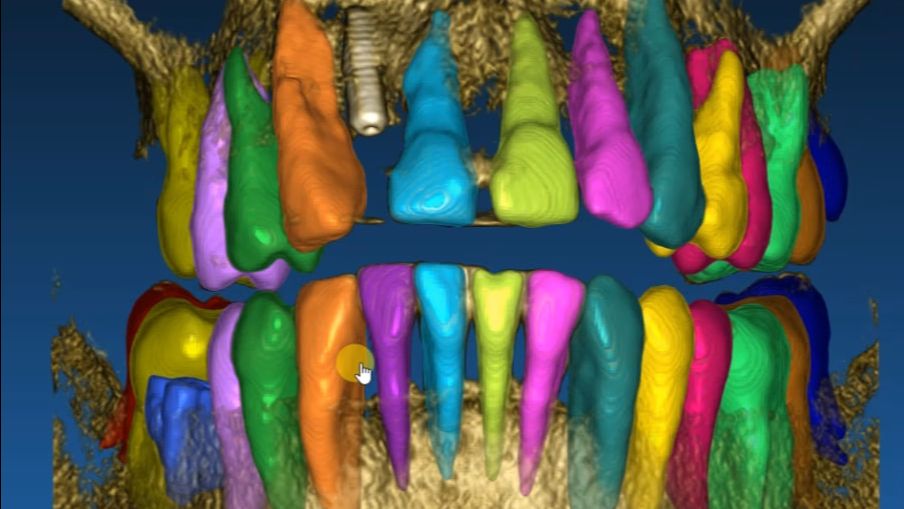 Сегментация корней из КТ для Maestro 3D. смотреть онлайн