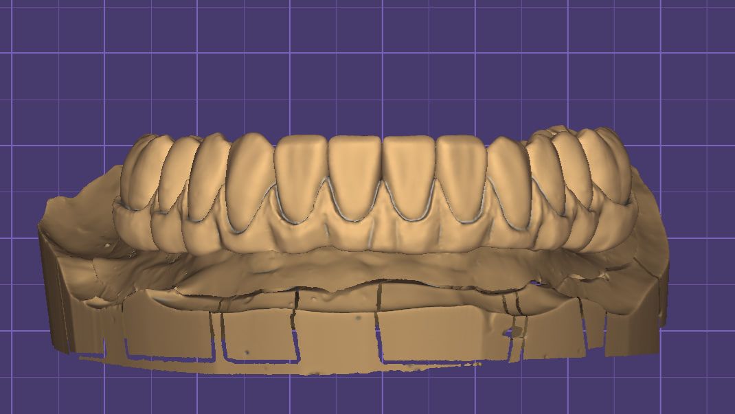 Моделирование искусственной десны для FP3 в Exocad. смотреть онлайн