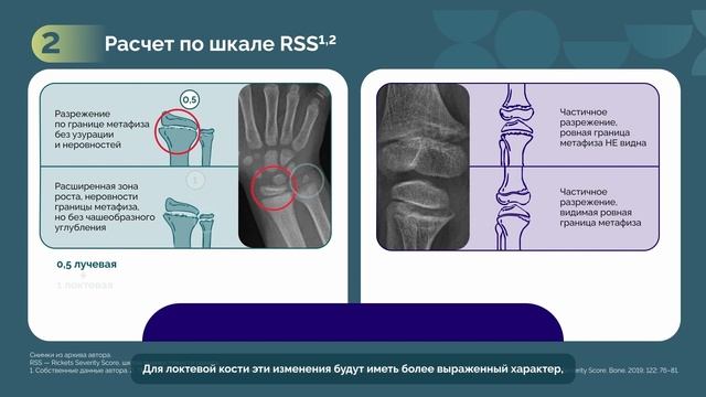 Рентгенологическая оценка тяжести проявлений рахита с помощью шкалы RSS (часть 2)