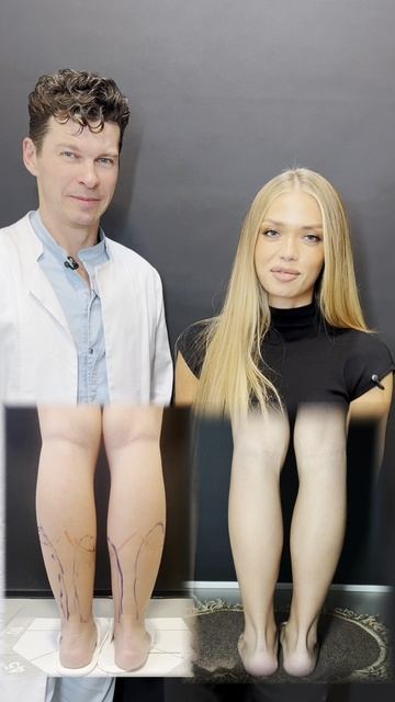 Отзыв пациентки после липоскульптуры голени! #сергейсвиридов смотреть онлайн