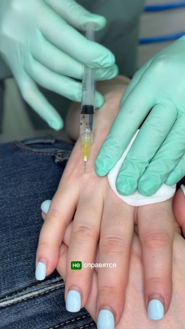 Биоревитализация кистей рук