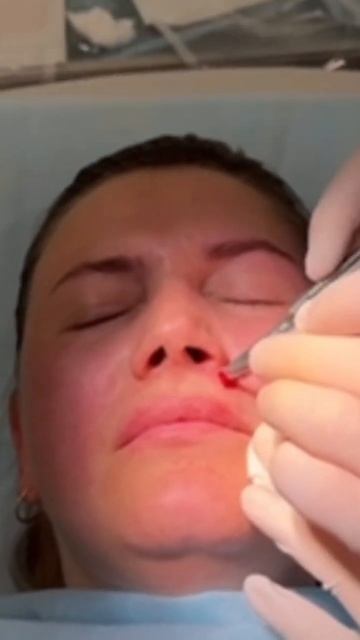 Панч-биопсия смотреть онлайн