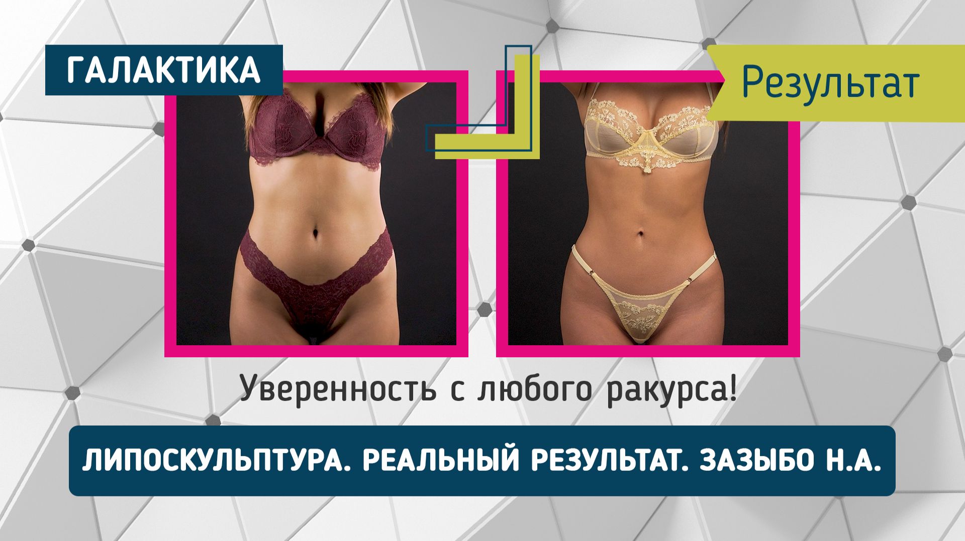 От плоских форм — до идеальных ягодиц! Результат от доктора Николая Зазыбо