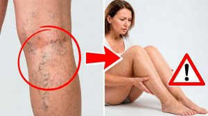 10 МИНУТ УПРАЖНЕНИЙ ПРИ ВАРИКОЗЕ: разгружаем вены и улучшаем кровоток