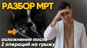 Разбор МРТ: 2 операции на грыжу не принесли эффекта