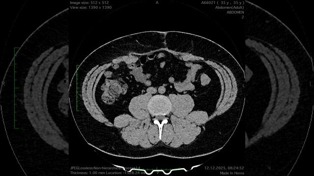 КТ расположения сетки не правильные методы