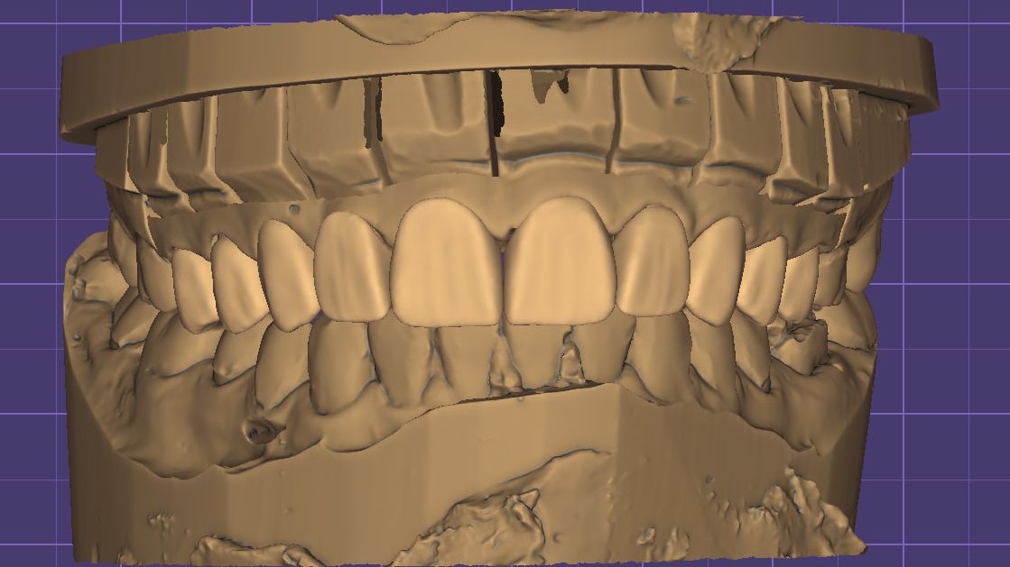 Моделирование виниров + корректировка зенитов смотреть онлайн