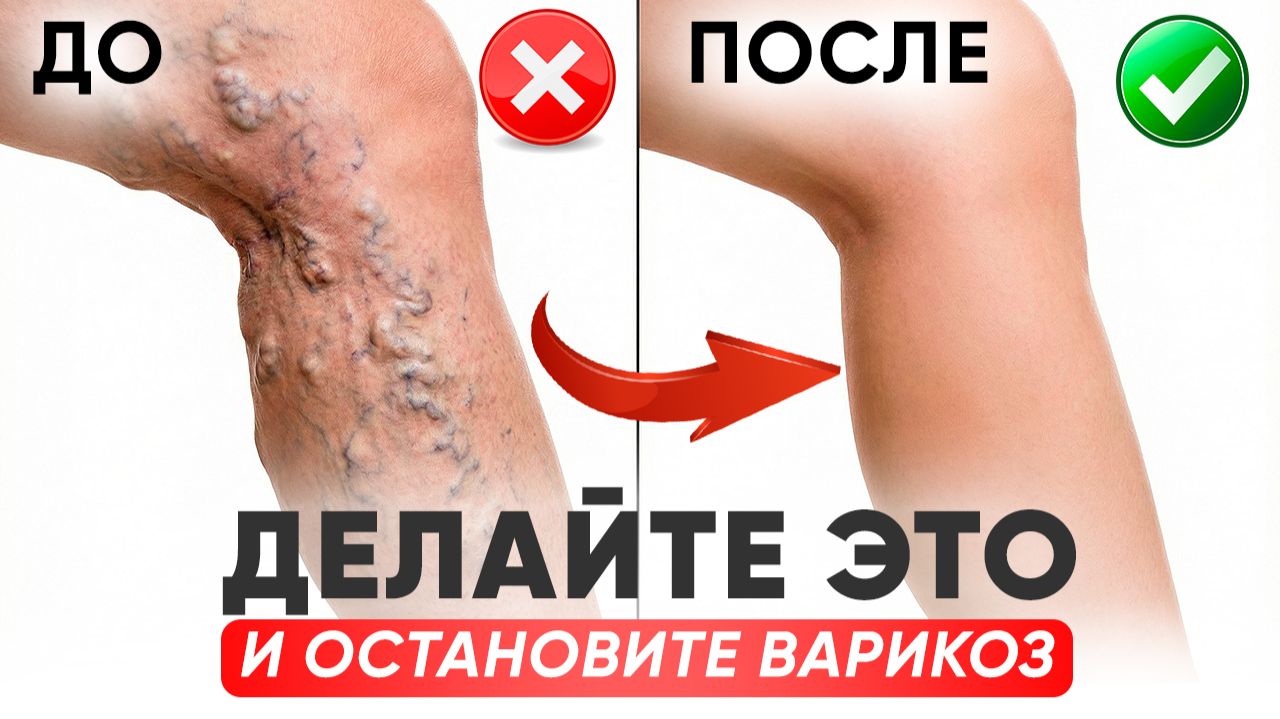 КАК ИЗБЕЖАТЬ ВАРИКОЗА ПОСЛЕ 40: простые упражнения для ног дома смотреть онлайн