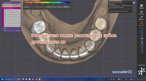 Мокап 35-45 ExoCad