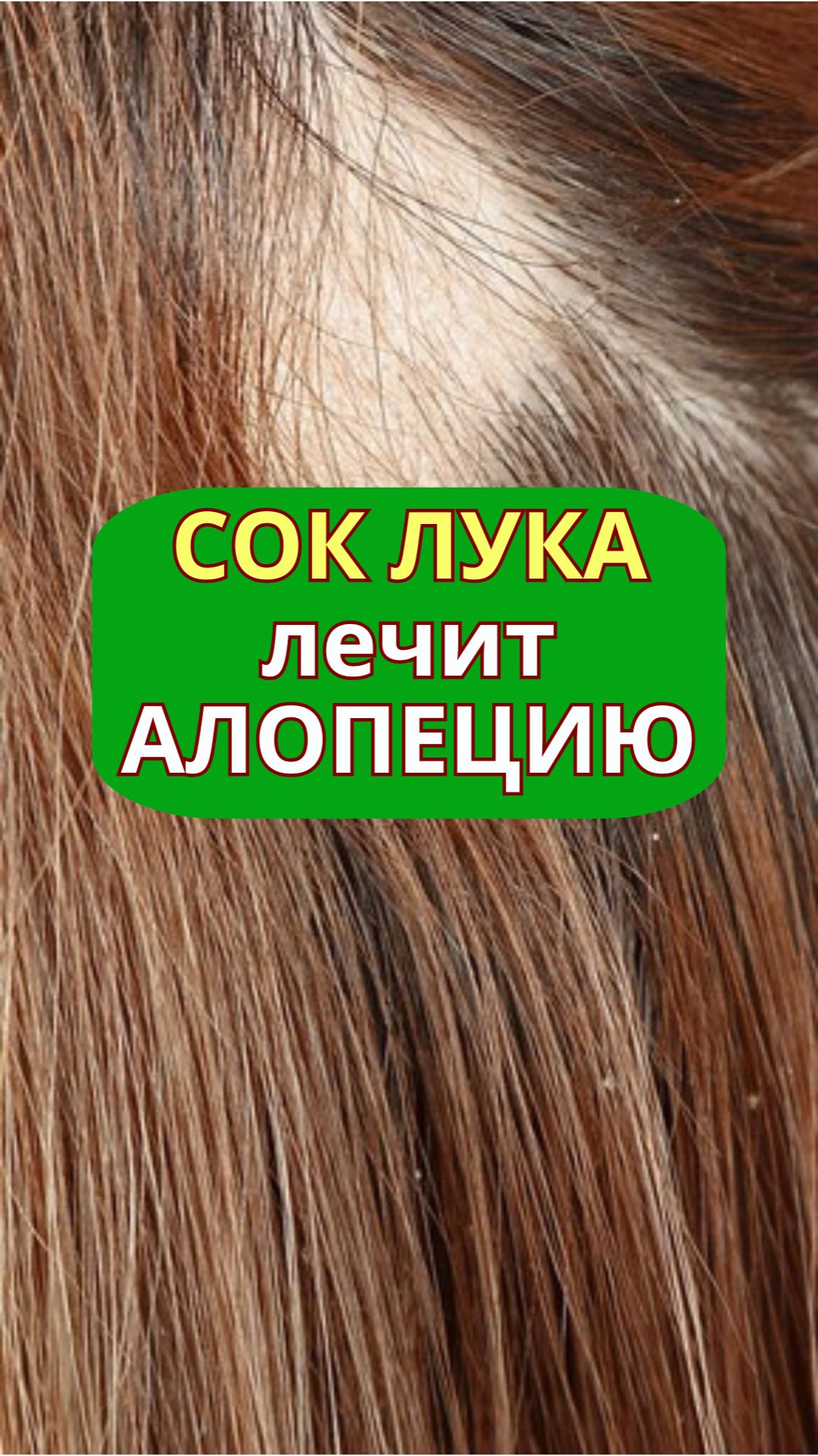 Сок ЛУКА лечит алопецию | alopecia.hair