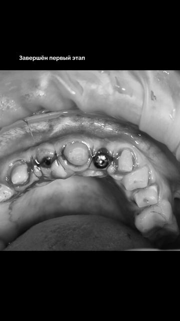 «Ни дня без зубов!!!» Это принцип стоматологии «Атлант», особенно, когда это зона улыбки #shots