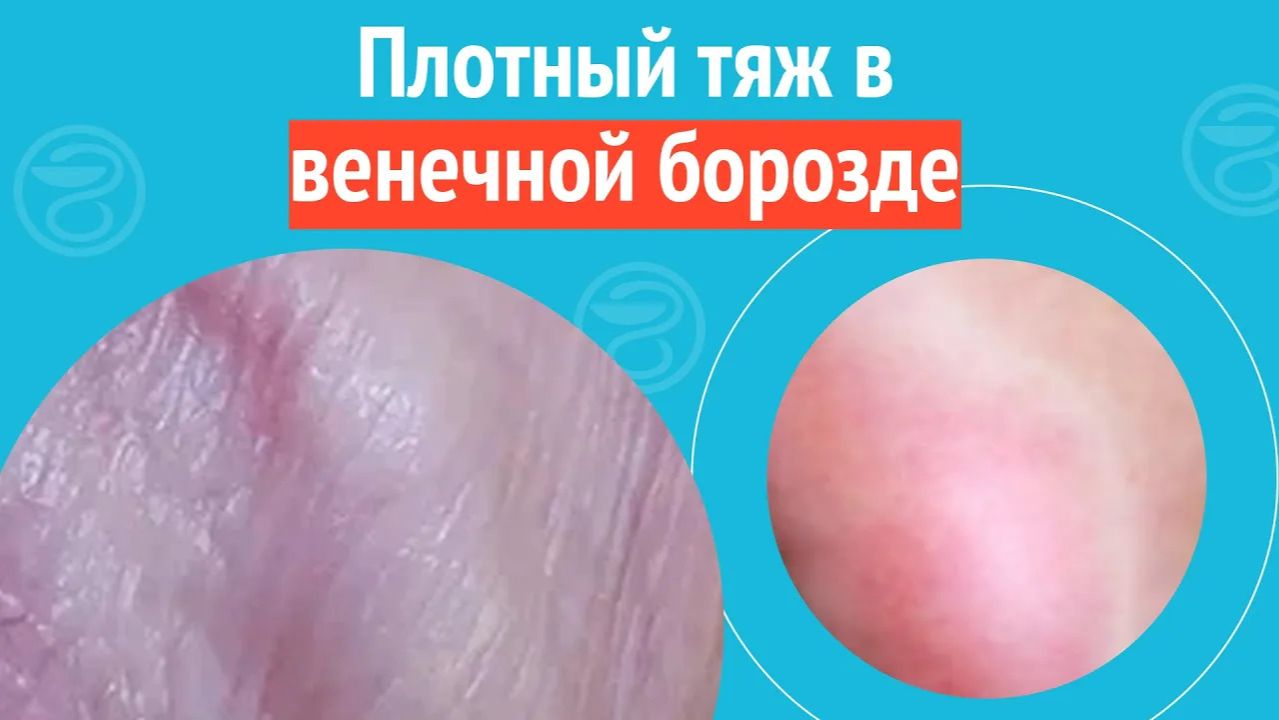 ➡️ Плотный тяж в венечной борозде. Клинический случай №1525 смотреть онлайн