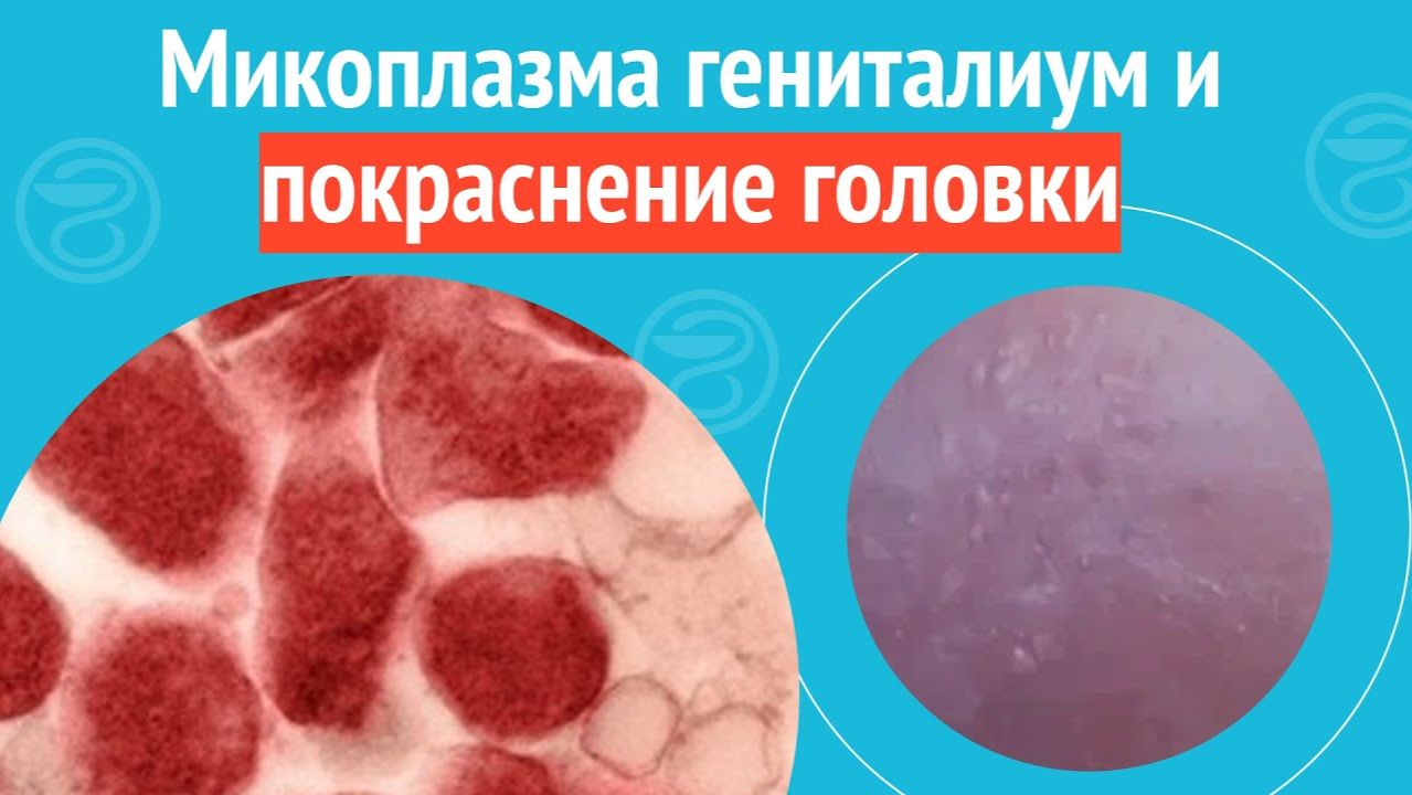 😒 Микоплазма гениталиум и покраснение головки. Клинический случай №1523 смотреть онлайн