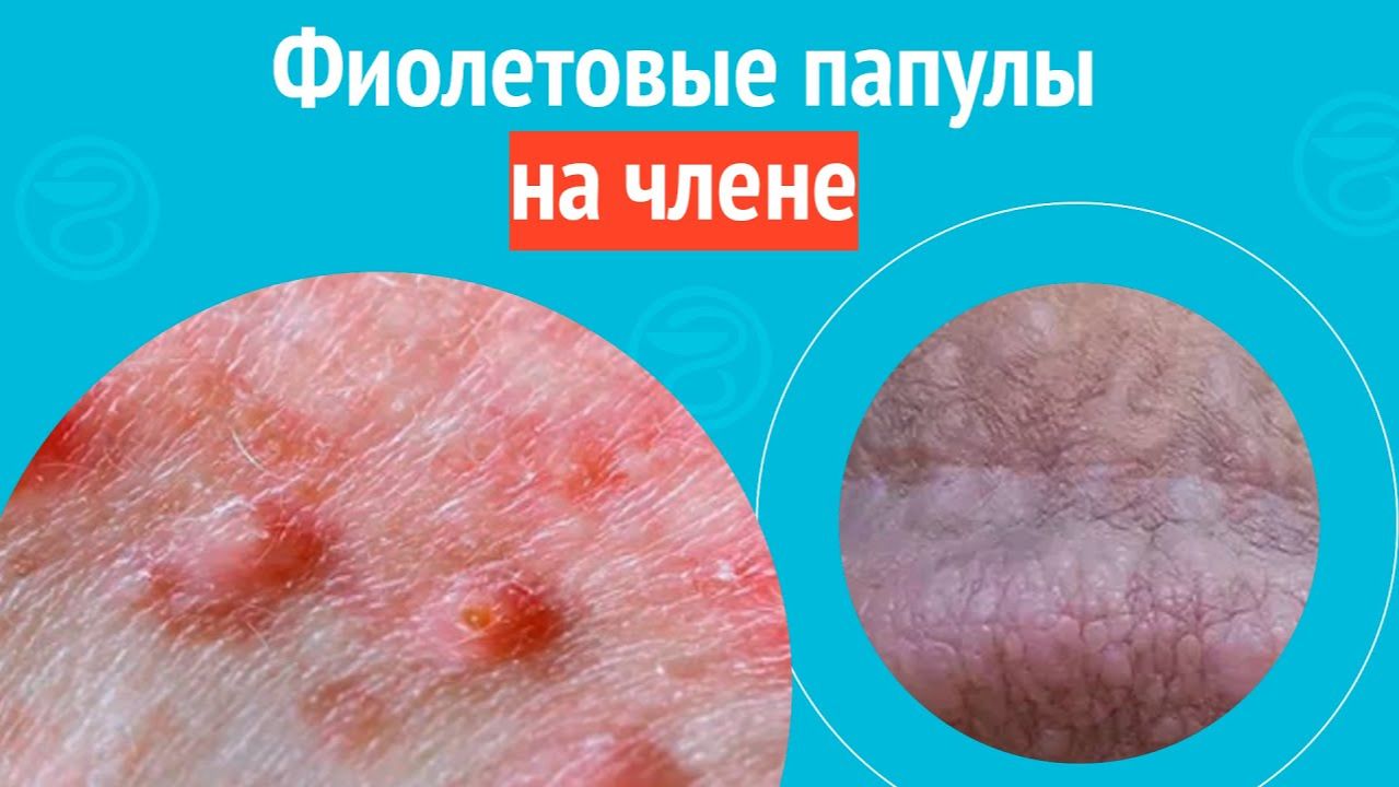 ▶️ Фиолетовые папулы на члене. Клинический случай №1530 смотреть онлайн