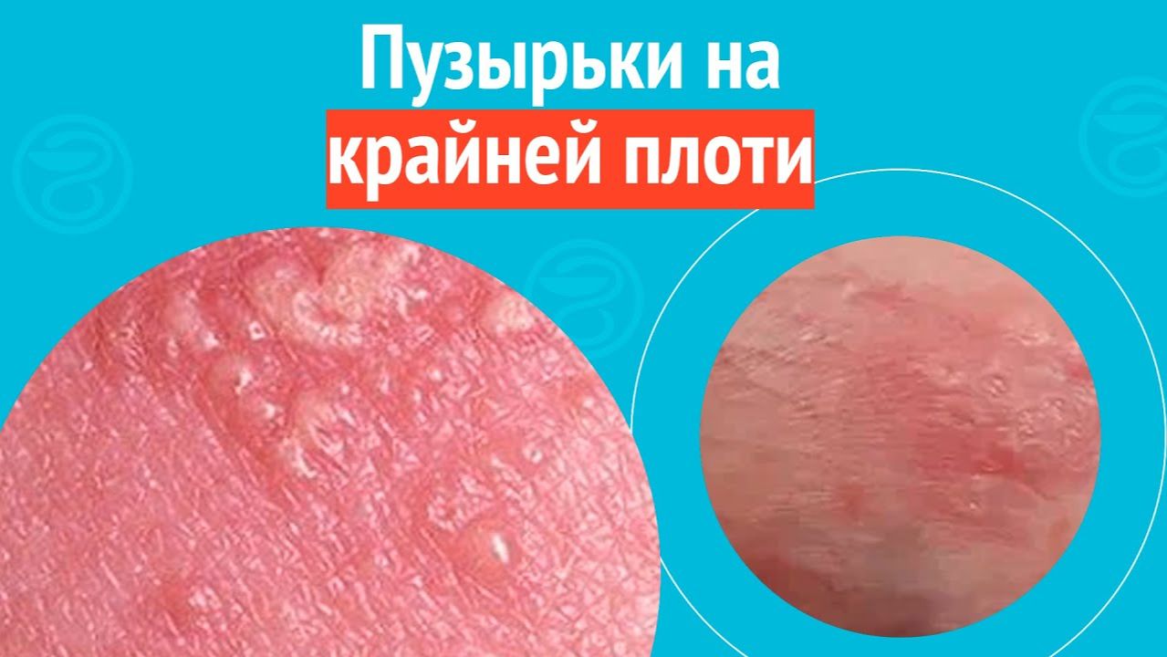 🫧 Пузырьки на крайней плоти. Клинический случай №1528 смотреть онлайн