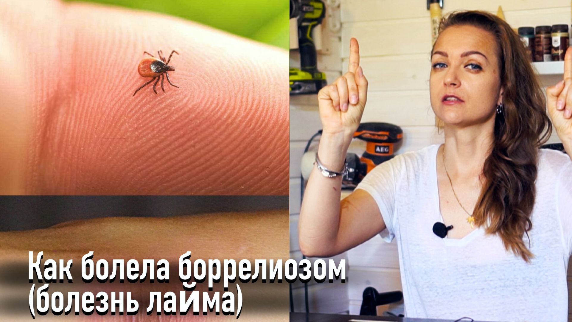 Как болела боррелиозом (болезнь лайма) смотреть онлайн