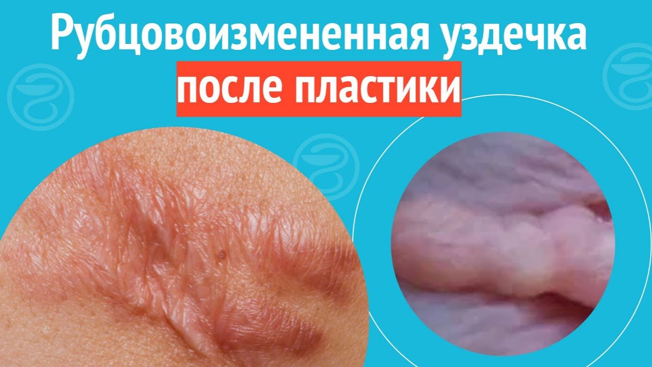 😧 Рубцовоизмененная уздечка после пластики. Клинический случай №1480 смотреть онлайн