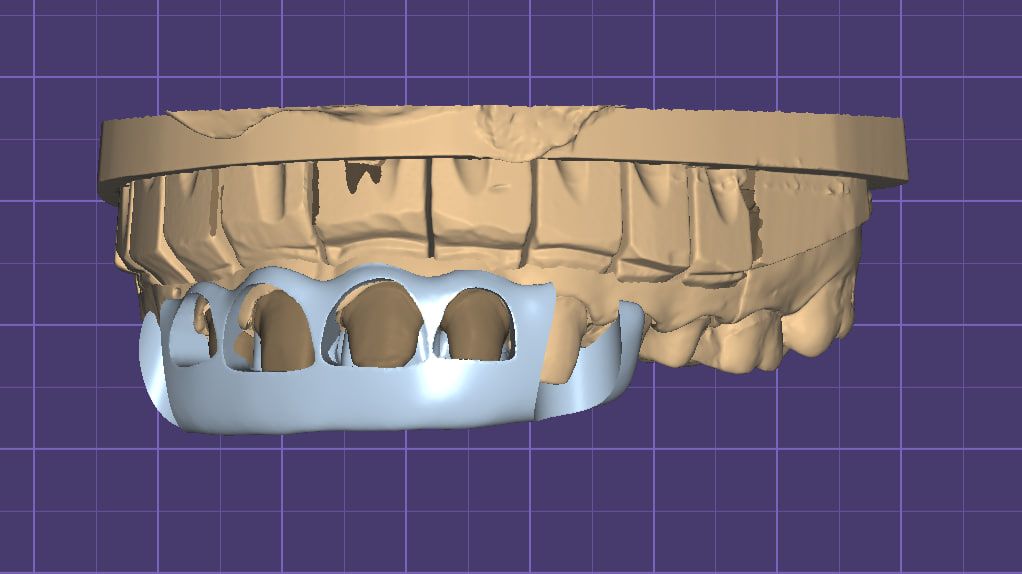 Шаблон для коррекции десны смотреть онлайн