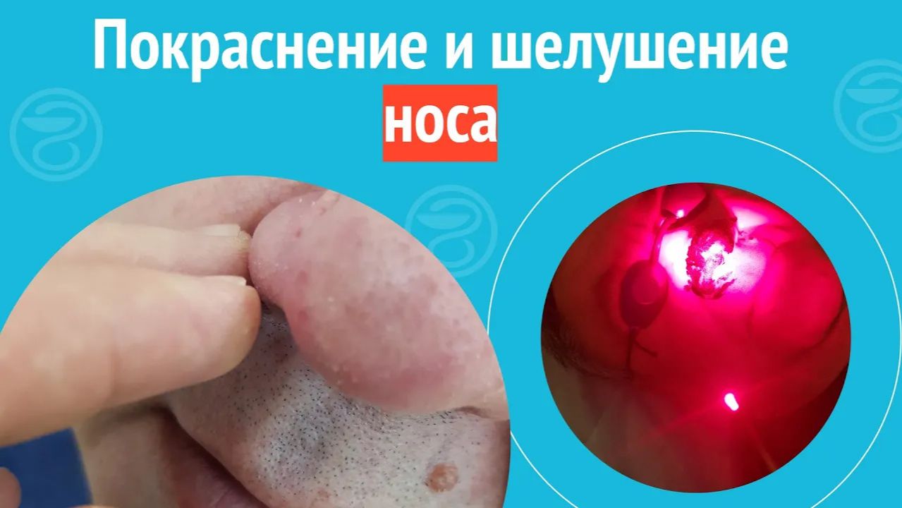 👃 Покраснение и шелушение носа. Клинический случай №1506 смотреть онлайн