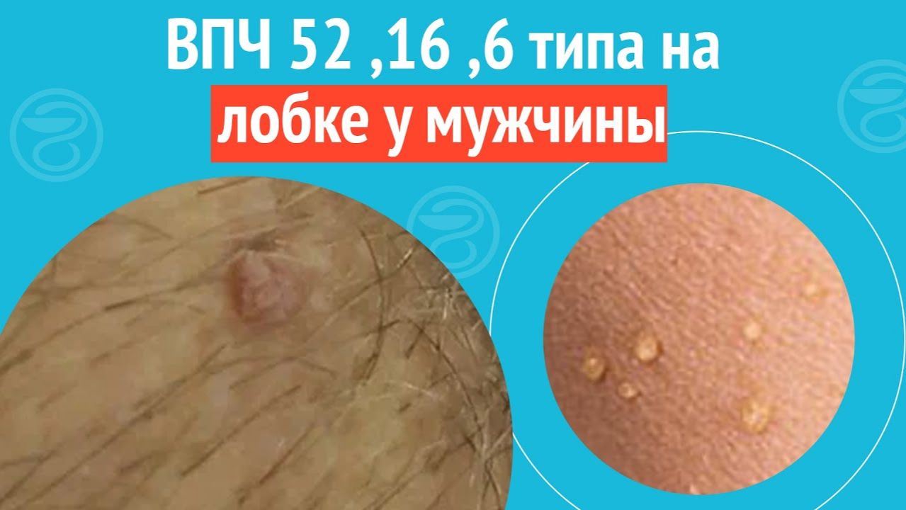 ⏩ ВПЧ 6, 16, 52 типа на лобке у мужчины. Клинический случай №1492 смотреть онлайн
