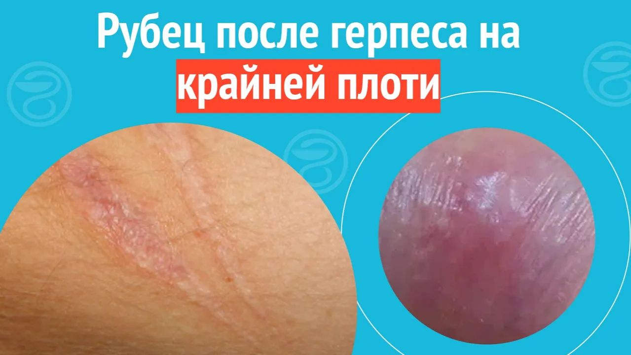 ➡️ Рубец после герпеса на крайней плоти. Клинический случай №1499 смотреть онлайн