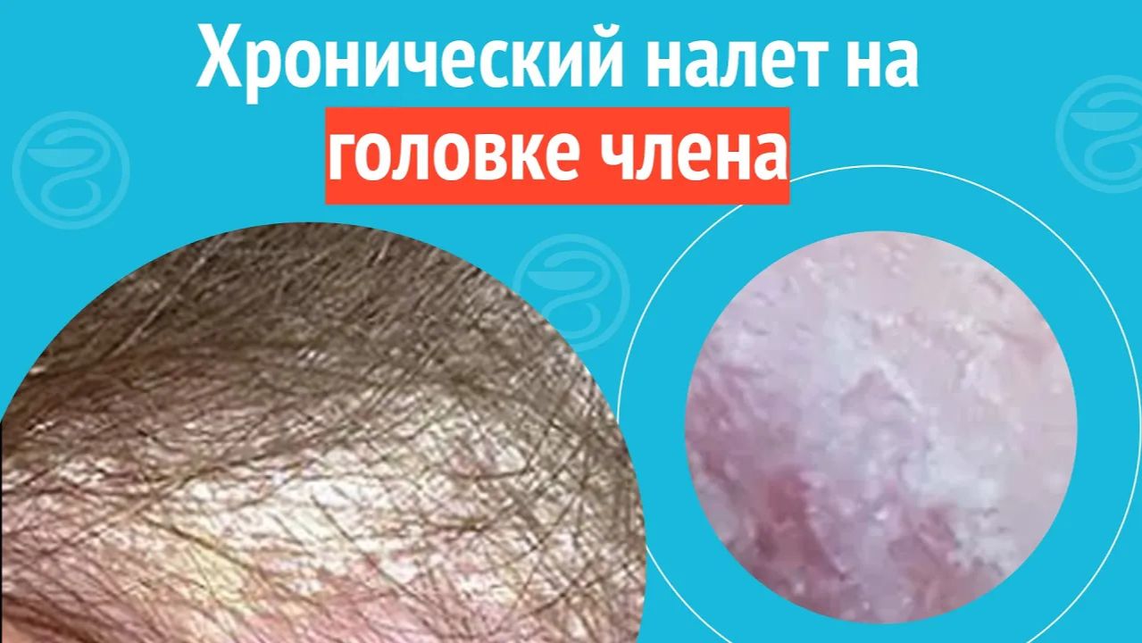 😒 Хронический налет на головке члена. Клинический случай №1512 смотреть онлайн