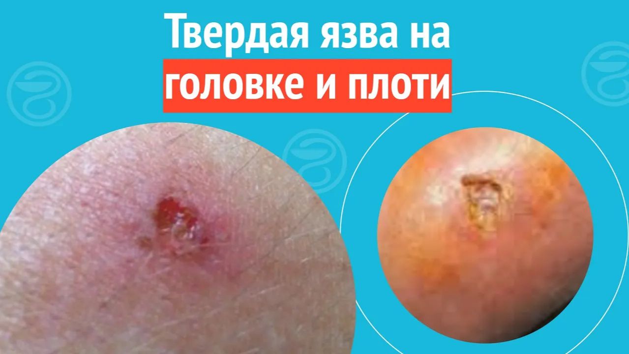 👉 Твердая язва на головке и плоти. Клинический случай №1504 смотреть онлайн