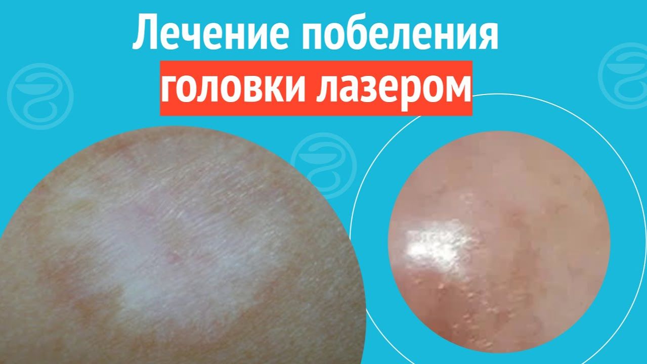 ⚕️ Лечение побеления головки лазером. Клинический случай №1513 смотреть онлайн