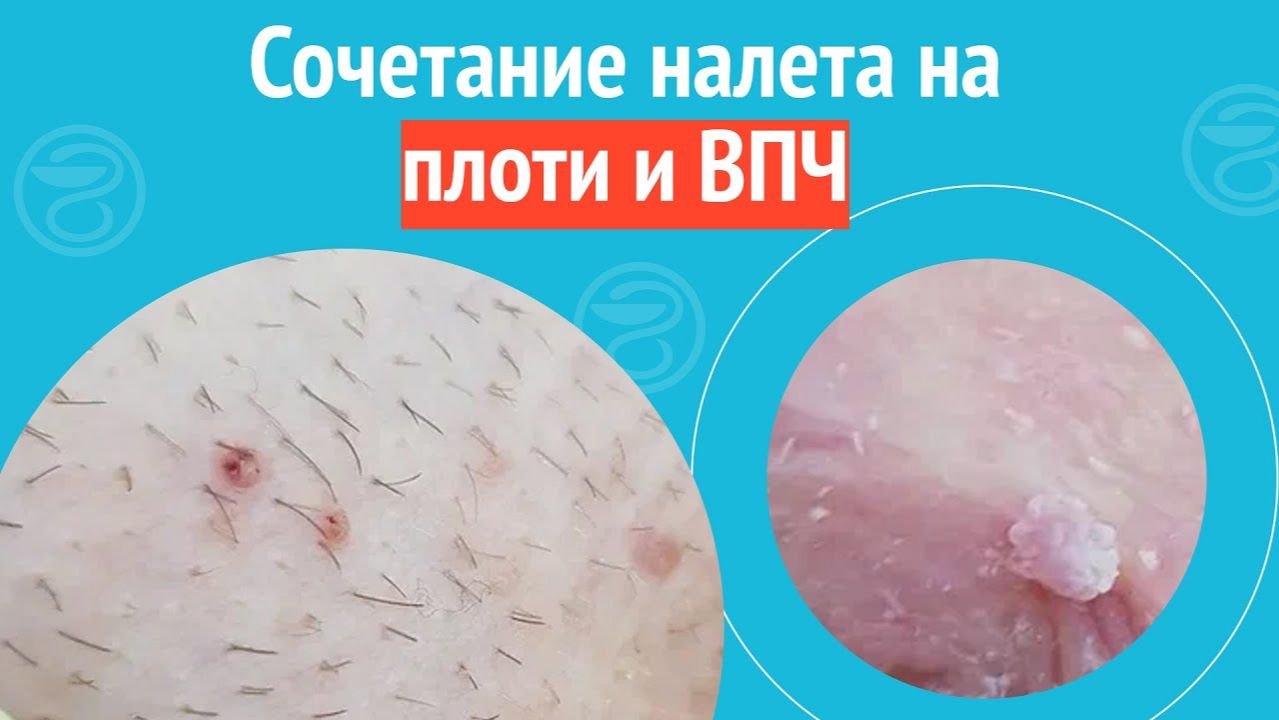 👉 Сочетание налета на плоти и ВПЧ. Клинический случай №1474 смотреть онлайн