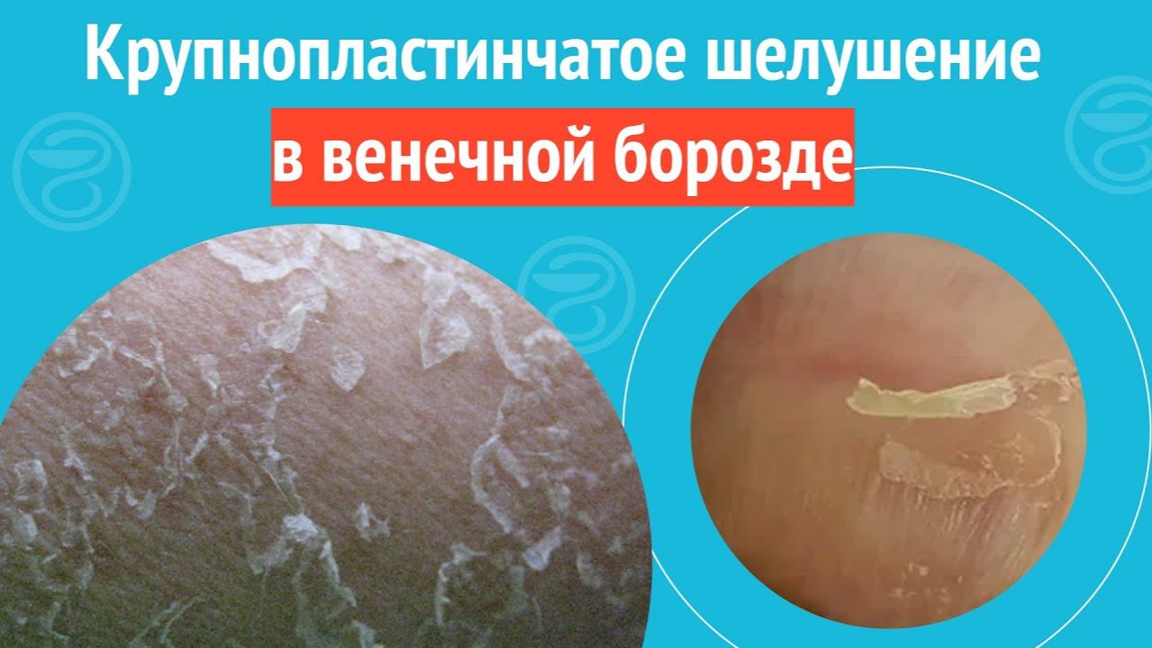 ▶️ Крупнопластинчатое шелушение в венечной борозде. Клинический случай №1482 смотреть онлайн