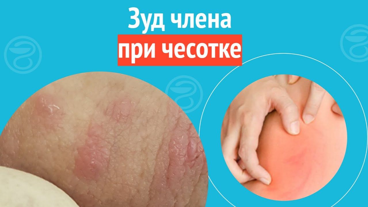 👉 Зуд члена при чесотке. Клинический случай №1477 смотреть онлайн